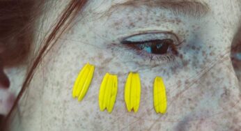 Laser to Remove Moles and Freckles